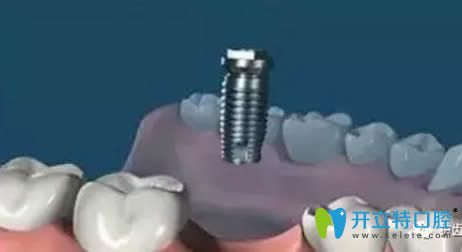 安裝愈合基臺(tái) 安裝愈合基臺(tái)