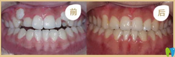 大連佳美口腔正畸前后效果對(duì)比圖