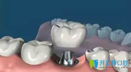 種植牙過(guò)程之戴上牙冠 種植牙過(guò)程之戴上牙冠