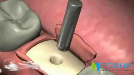 種植牙手術(shù)過(guò)程之植入種植體 種植牙手術(shù)過(guò)程之植入種植體