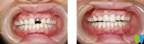 昆明尚愛韓美口腔李兵院長種植牙案例效果圖