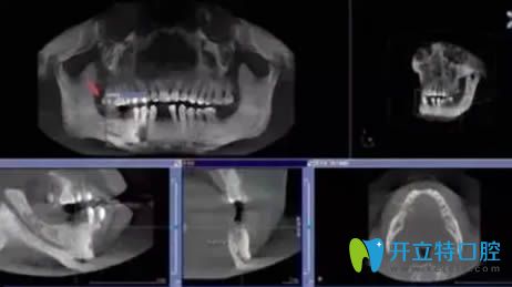 種植牙過程分為幾個步驟?看完這幾張圖解就知道種牙不痛苦