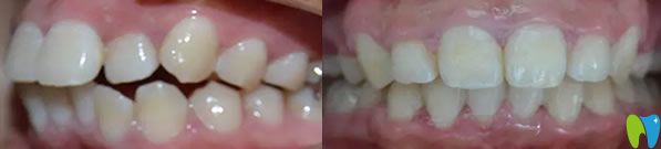 齙牙矯正前后效果對比圖