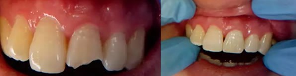 門牙斷裂怎么辦及修復(fù)方法 大連美麗雅口腔聞院長詳細(xì)解答