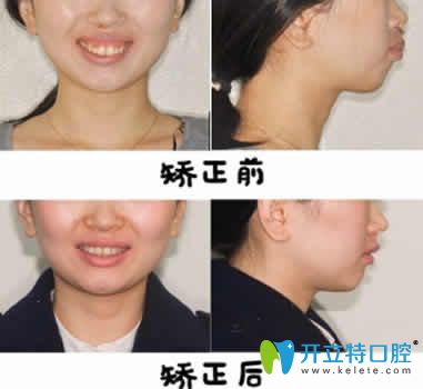 昆明尚愛韓美口腔申晶院長(zhǎng)隱形牙齒矯正案例圖
