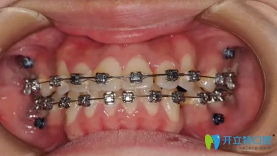 牙套的種類及價格解析 看完就知道選擇哪種牙齒矯正器好了