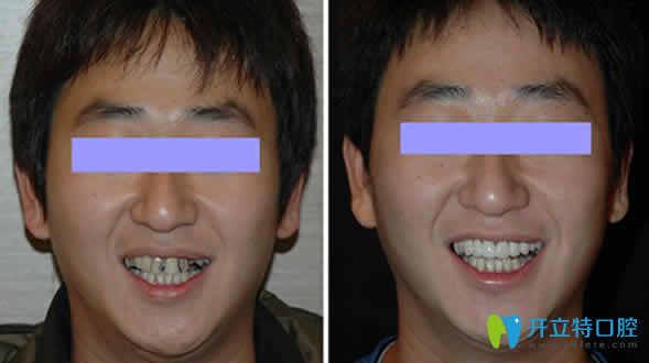 牙齒美容冠前后對(duì)比照片