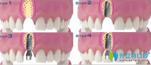 開(kāi)立特口腔網(wǎng)牙齒種植圖解