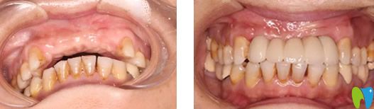 成都新橋口腔種牙前后效果對比