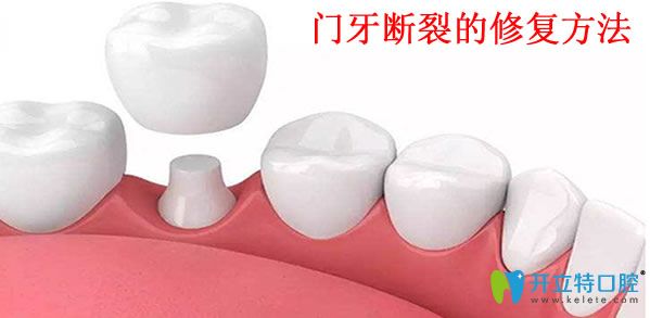 美麗雅口腔門牙斷裂的修復(fù)方法 美麗雅口腔門牙斷裂的修復(fù)方法