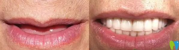 聞?dòng)钤洪L(zhǎng)全口牙缺失即刻種植牙種植案例