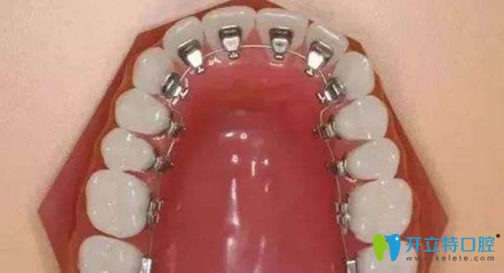 牙套的種類之舌側(cè)隱形矯正器