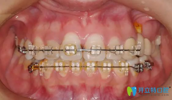 牙套的種類之陶瓷托槽矯正器