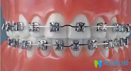 牙套的種類之自鎖托槽矯正器