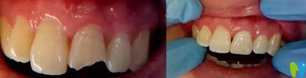 門牙缺失美容冠修復(fù)代表案例 門牙缺失美容冠修復(fù)代表案例