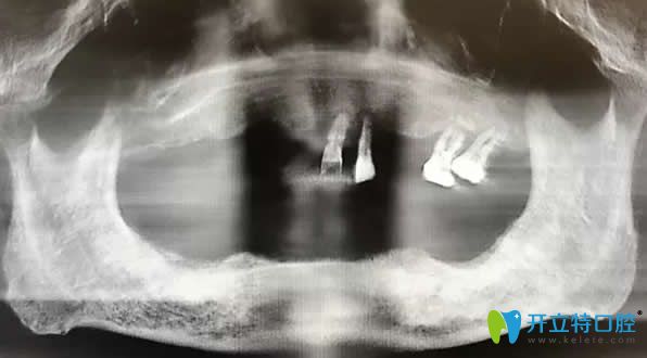 78歲老人在南京牙博士口腔種植牙齒后感嘆 價格高但效果好