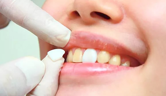 牙齒黃怎么辦 我們都想知道美白牙齒的方法及價(jià)格要多少錢