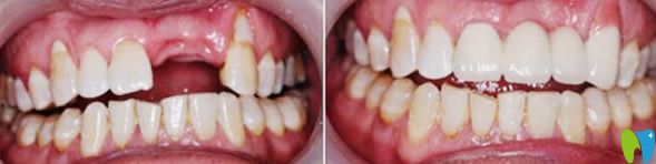 廣州德仁口腔種植牙效果案例 廣州德仁口腔種植牙效果案例