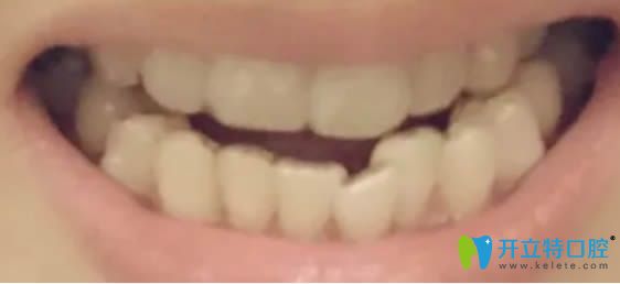 寫(xiě)一篇我去上海華美花4萬(wàn)元讓張群做隱適美牙齒矯正的感受