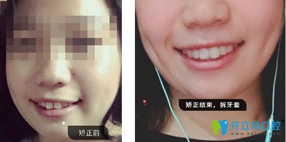 德仁口腔隱適美隱形矯正牙齒前后效果對(duì)比案例 德仁口腔隱適美隱形矯正牙齒前后效果對(duì)比案例