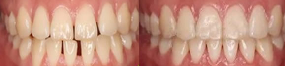 隱形矯正牙齒有用嗎 分享大連美麗雅口腔牙齒稀疏矯正經(jīng)歷