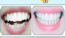 齙牙在廣州歐頓口腔做隱形矯正650天，來曬牙齒變化圖啦