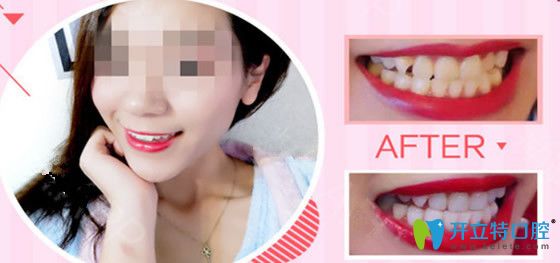 歐頓口腔納米炫薄瓷貼面修復牙齒案例