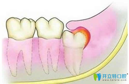 請問急性冠周炎怎么治療？提供全面的治療方法
