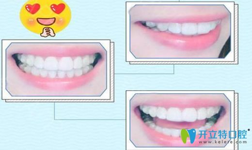 去廣州歐頓口腔做隱性矯正第650天效果圖