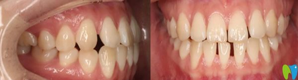 大連美麗雅口腔牙齒矯正前