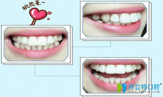戴隱形牙套第300天牙齒變化圖