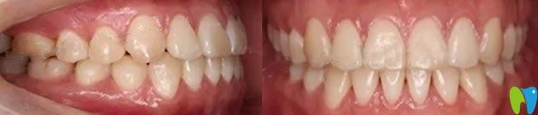 大連美麗雅口腔隱形牙齒矯正術后效果圖