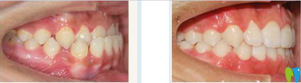 南寧柏樂口腔門牙反頜矯正前后對比<span style=
