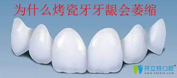 為什么做了烤瓷牙牙齦會(huì)萎縮
