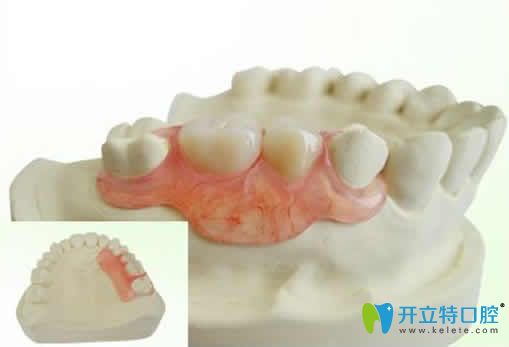 什么是隱形義齒