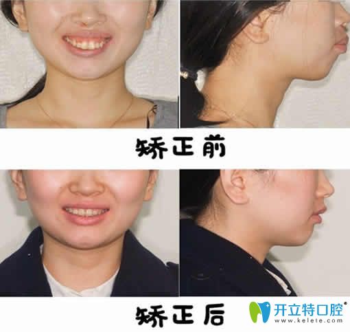 福州晶特爾口腔牙齒矯正效果對比圖