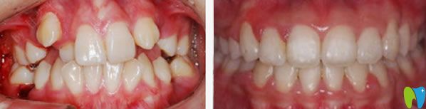 李爽主任牙齒不齊矯正案例
