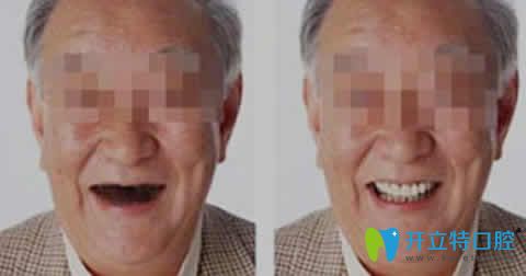 福州晶特爾口腔王思興種植牙案例效果圖