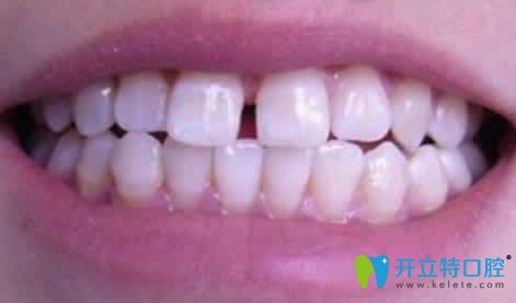 兩顆門牙中間有縫怎么辦能做矯正嗎？看資深牙醫(yī)詳解