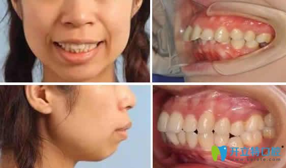 看過我在福州晶特爾口腔做牙齒矯正前后照片都說臉型變了