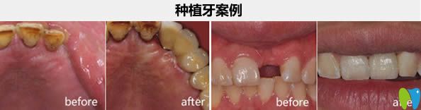 南昌維樂口腔汪文文種植牙實(shí)例