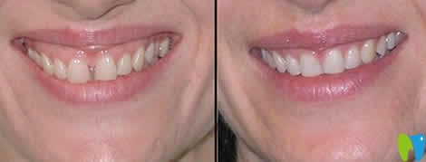門牙中間有縫矯正前后對比圖