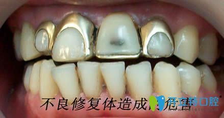 開立特口腔不良修復(fù)體造成的危害