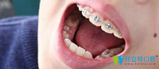 牙齒正畸醫(yī)生李永剛科普兒童牙齒矯正的年齡