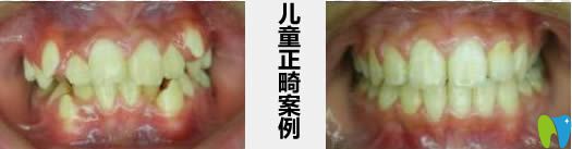 成都君臣兒童正畸案例及前后對比照