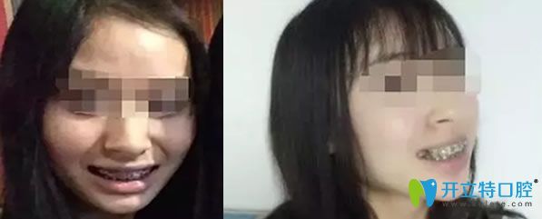 牙齒矯正戴上牙套后