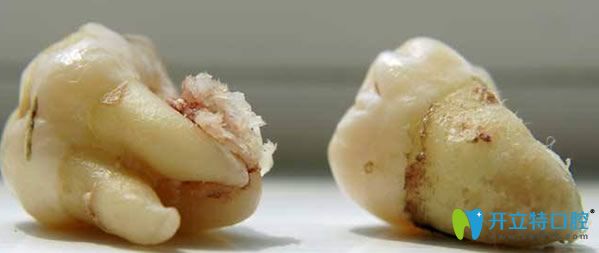 智齒發(fā)炎了怎么辦可以拔牙嗎？看看你了解多少