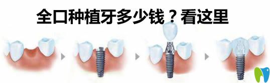 汪文文醫(yī)生告訴你全口種植牙多少錢(qián)