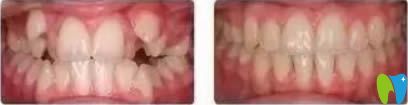 西安海濤口腔程錦醫(yī)生兒童牙齒矯正前后對(duì)比照