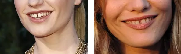 求問：牙縫大怎么辦如何矯正 樹脂補牙縫和全瓷牙選哪個好